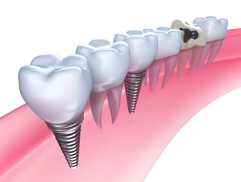 Burbank dental implants